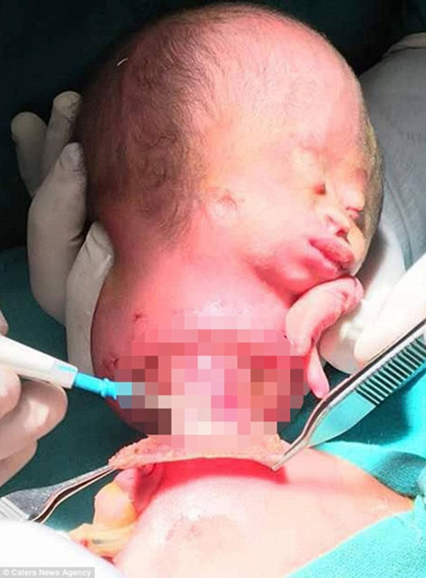 Foto - Gövdesine yapışık bir kafayla doğdu