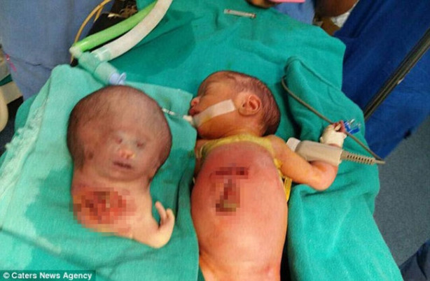 Foto - Gövdesine yapışık bir kafayla doğdu