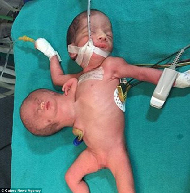 Foto - Gövdesine yapışık bir kafayla doğdu