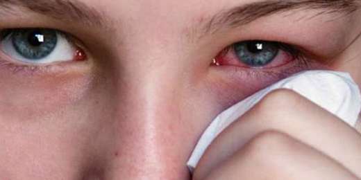 Foto - Göz alerjisi nedir, çeşitleri nelerdir, nasıl geçer?