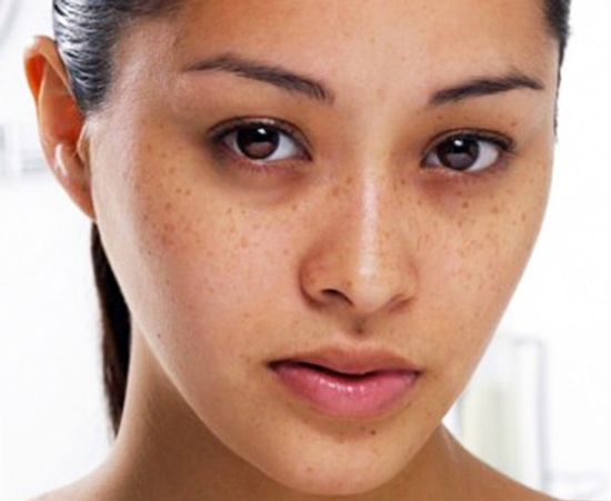 Foto - Göz altı morluğunun sebepleri