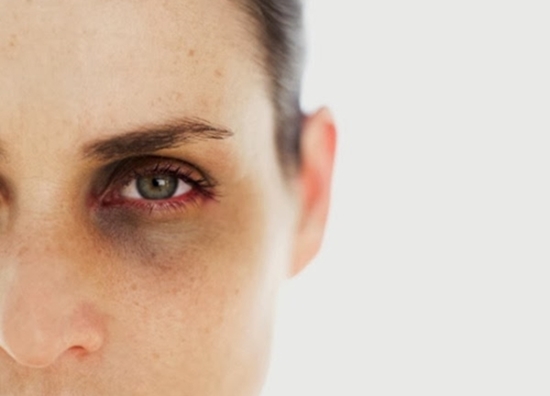 Foto - Göz altı morluğunun sebepleri