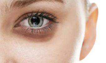 Foto - Göz Altı Morlukları Neden Olur? Canan Karatay 'Çok Büyük Belirti' diyerek resmen açıkladı!