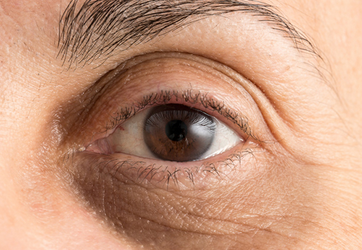 Foto - Göz Altı Morlukları Neden Olur? Canan Karatay 'Çok Büyük Belirti' diyerek resmen açıkladı!