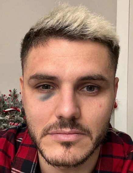 Foto - Göz Altı Morlukları Neden Olur? Canan Karatay 'Çok Büyük Belirti' diyerek resmen açıkladı!