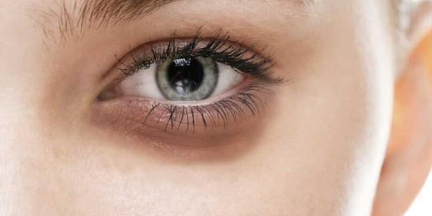 Göz altındaki morluklar kader değil! Tembel damarları çalıştırarak tedavi ediyor