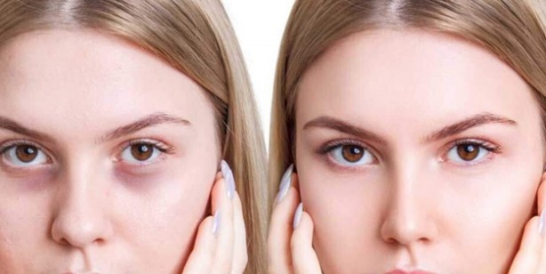 Foto - Göz altındaki morluklar kader değil! Tembel damarları çalıştırarak tedavi ediyor