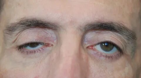 Foto - Göz kapağı düşük olanlar dikkat! Bu hareket ve maskeyle kaldırılabiliyor