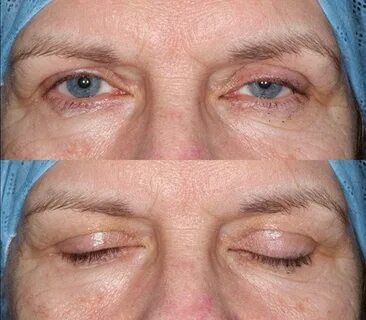 Foto - Göz kapağı düşük olanlar dikkat! Bu hareket ve maskeyle kaldırılabiliyor