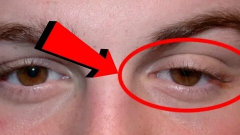 Göz kapağı düşük olanlar dikkat! Bu hareket ve maskeyle kaldırılabiliyor