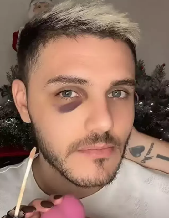 Foto - Göz morluğu gündem oldu! Flaş açıklama geldi: İşi şova döktüler! Futbolu unutunca Nara devreye girdi...