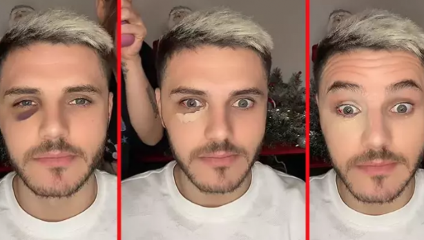 Foto - Göz morluğu gündem oldu! Flaş açıklama geldi: İşi şova döktüler! Futbolu unutunca Nara devreye girdi...