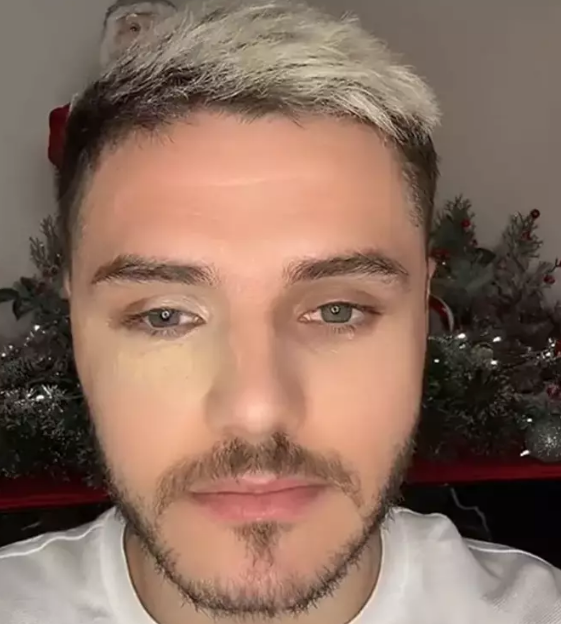 Göz morluğu gündem oldu! Flaş açıklama geldi: İşi şova döktüler! Futbolu unutunca Nara devreye girdi...