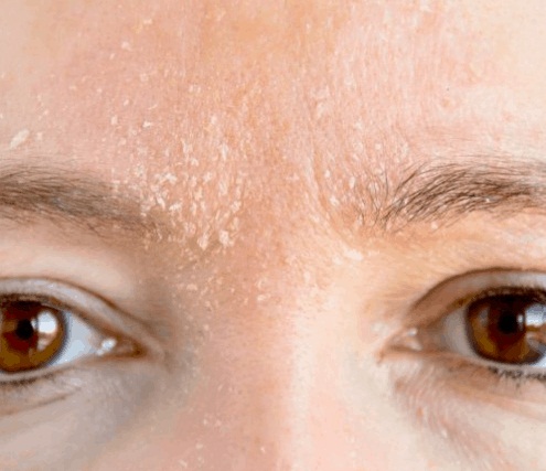 Foto - Gözenekler neden belirginleşir?