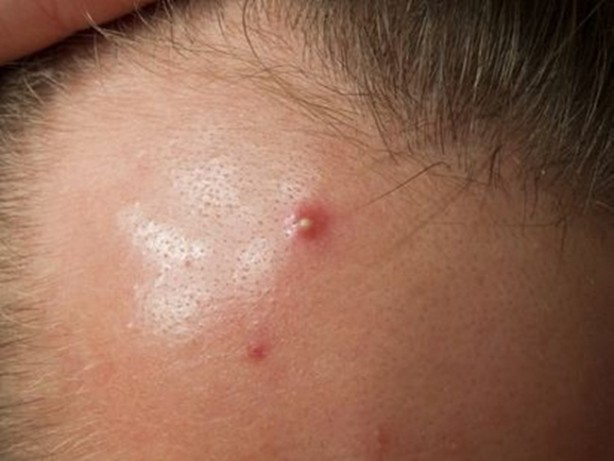 Foto - Gözenekler neden belirginleşir?