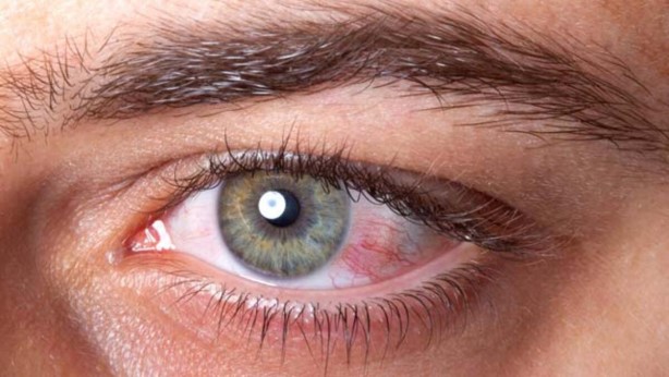 Foto - Gözlere dikkat! Koronavirüs işareti olabilir