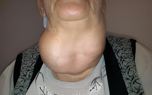 Foto - Gözleri yerinden çıkaran hastalığa dikkat! Uzmanı uyardı: Bu belirtiler varsa...