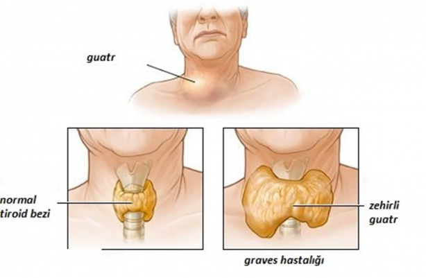 Foto - Gözleri yerinden çıkaran hastalığa dikkat! Uzmanı uyardı: Bu belirtiler varsa...