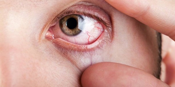 Foto - Gözlerinde bu belirtiler olanlar aman dikkat! Ani ölüme bile yol açabiliyor! Çok ama çok kötü bir şey