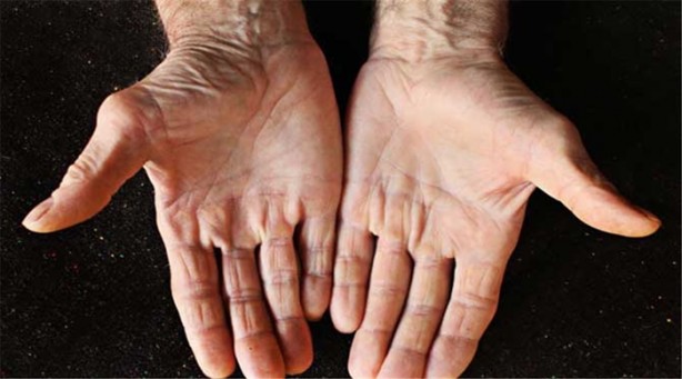 Foto - Gözlerinizde beyaz çizgi varsa dikkat!