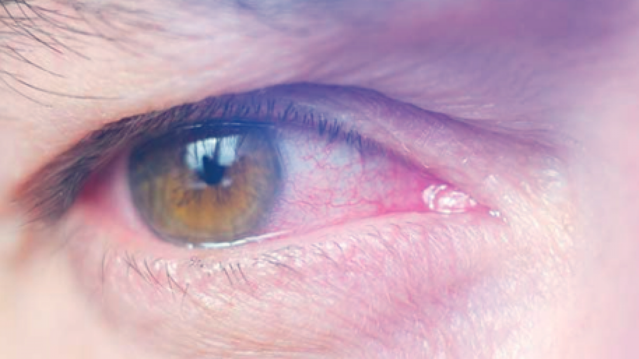 Gözün ‘sessiz hırsızı’ Glokom: Fark ettiğinizde çok geç olabilir
