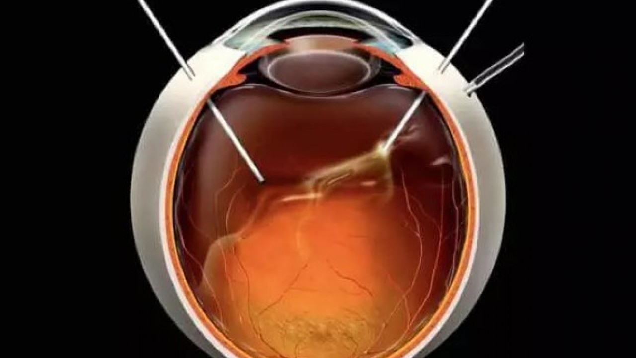 Foto - Gözünden çıkana doktorlar inanamadı: 8 ay farketmeden yaşamış!