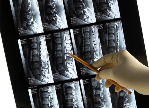 Günlük hayatta yapılan bu hataya dikkat edin! Kemik erimesi sebebi