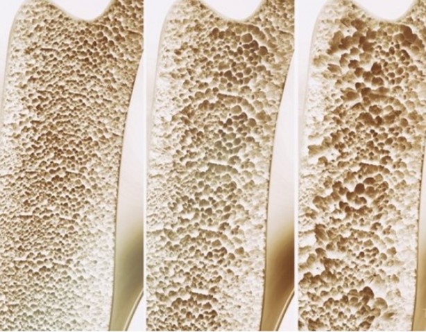 Foto - Günlük hayatta yapılan bu hataya dikkat edin! Kemik erimesi sebebi