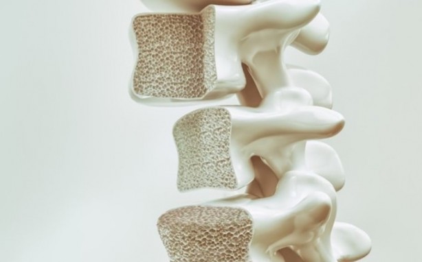 Foto - Günlük hayatta yapılan bu hataya dikkat edin! Kemik erimesi sebebi