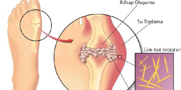 Gut hastalığına iyi gelen en iyi 4 besin