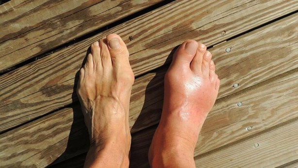 Foto - Gut hastalığına yol açan Ürik asidi azaltmanın yolları