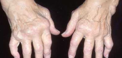 Foto - Gut hastalığına yol açan Ürik asidi azaltmanın yolları