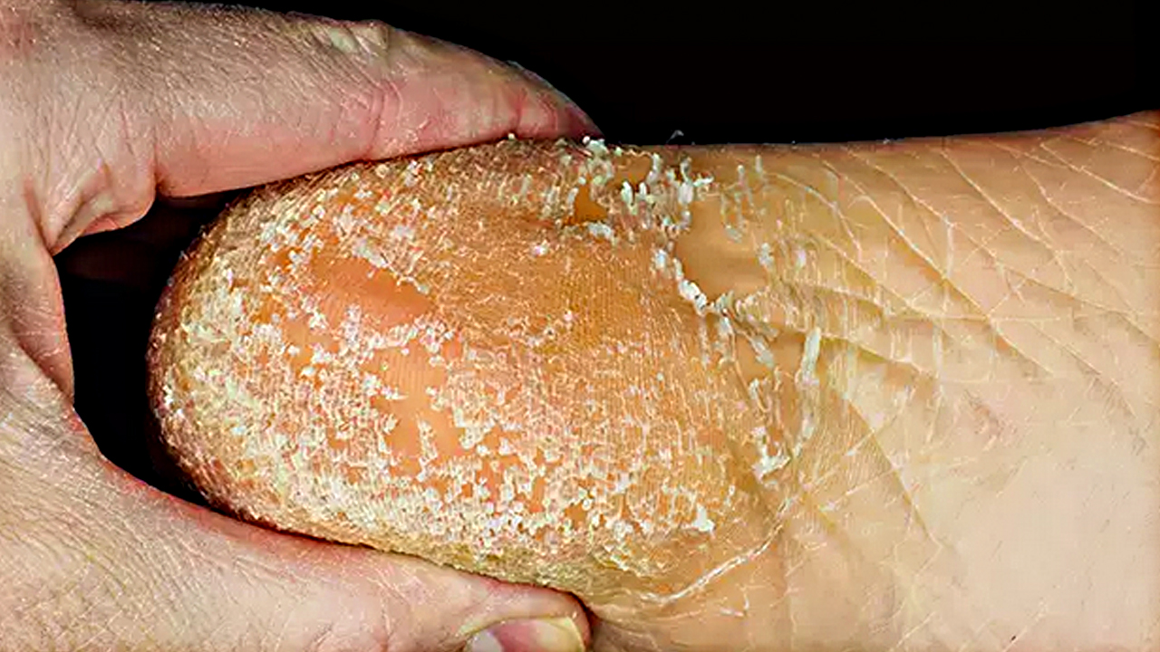 Foto - Güzellik uğruna yara eden var! Çatlayan topuk böyle iyileşiyor… O acılar teker teker düşecek…