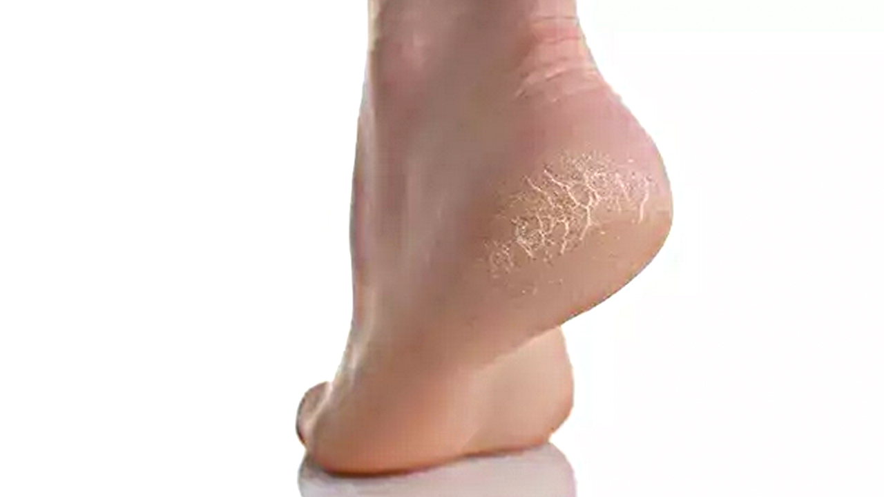 Foto - Güzellik uğruna yara eden var! Çatlayan topuk böyle iyileşiyor… O acılar teker teker düşecek…