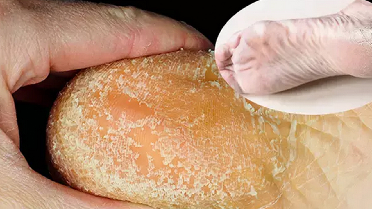 Güzellik uğruna yara eden var! Çatlayan topuk böyle iyileşiyor… O acılar teker teker düşecek…