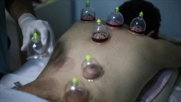 Foto - Hacamat nedir? Nasıl yapılır? Faydaları ve hangi hastalıklara iyi gelir?