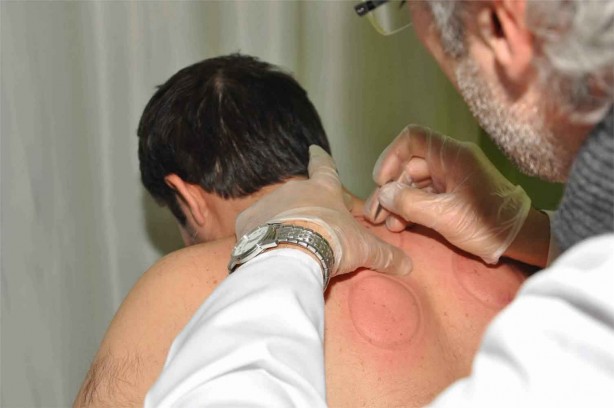 Foto - Hacamat nedir? Nasıl yapılır? Faydaları ve hangi hastalıklara iyi gelir?