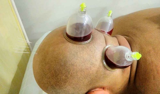 Foto - Hacamat nedir? Nasıl yapılır? Faydaları ve hangi hastalıklara iyi gelir?