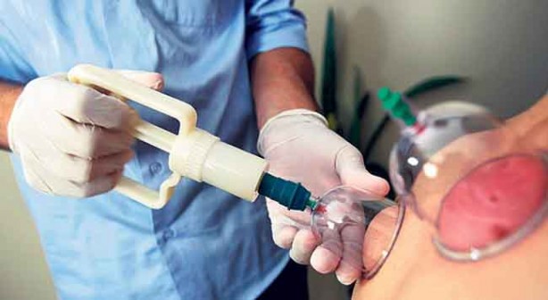 Foto - Hacamat nedir? Nasıl yapılır? Faydaları ve hangi hastalıklara iyi gelir?