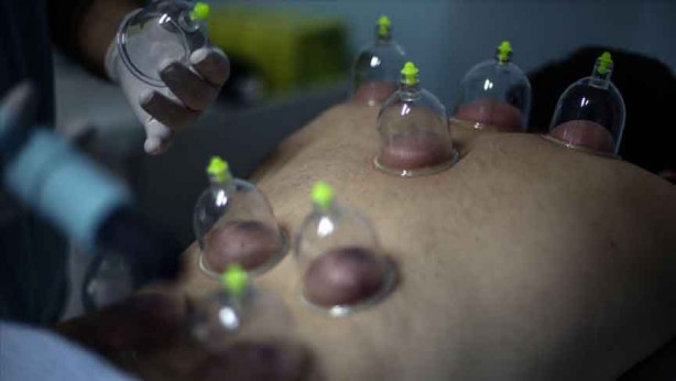 Foto - Hacamat nedir? Nasıl yapılır? Faydaları ve hangi hastalıklara iyi gelir?