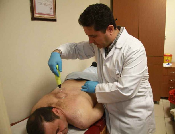 Foto - Hacamat nedir? Nasıl yapılır? Faydaları ve hangi hastalıklara iyi gelir?