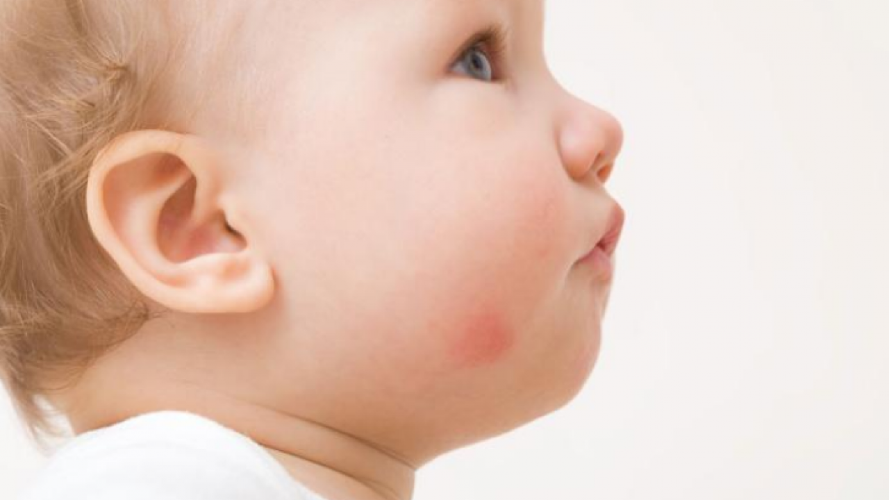 Foto - Hamileler ve çocuklarda besin alerjisine karşı alınması gereken önlemler! 