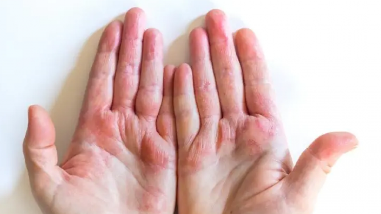 Foto - Hamileler ve çocuklarda besin alerjisine karşı alınması gereken önlemler! 