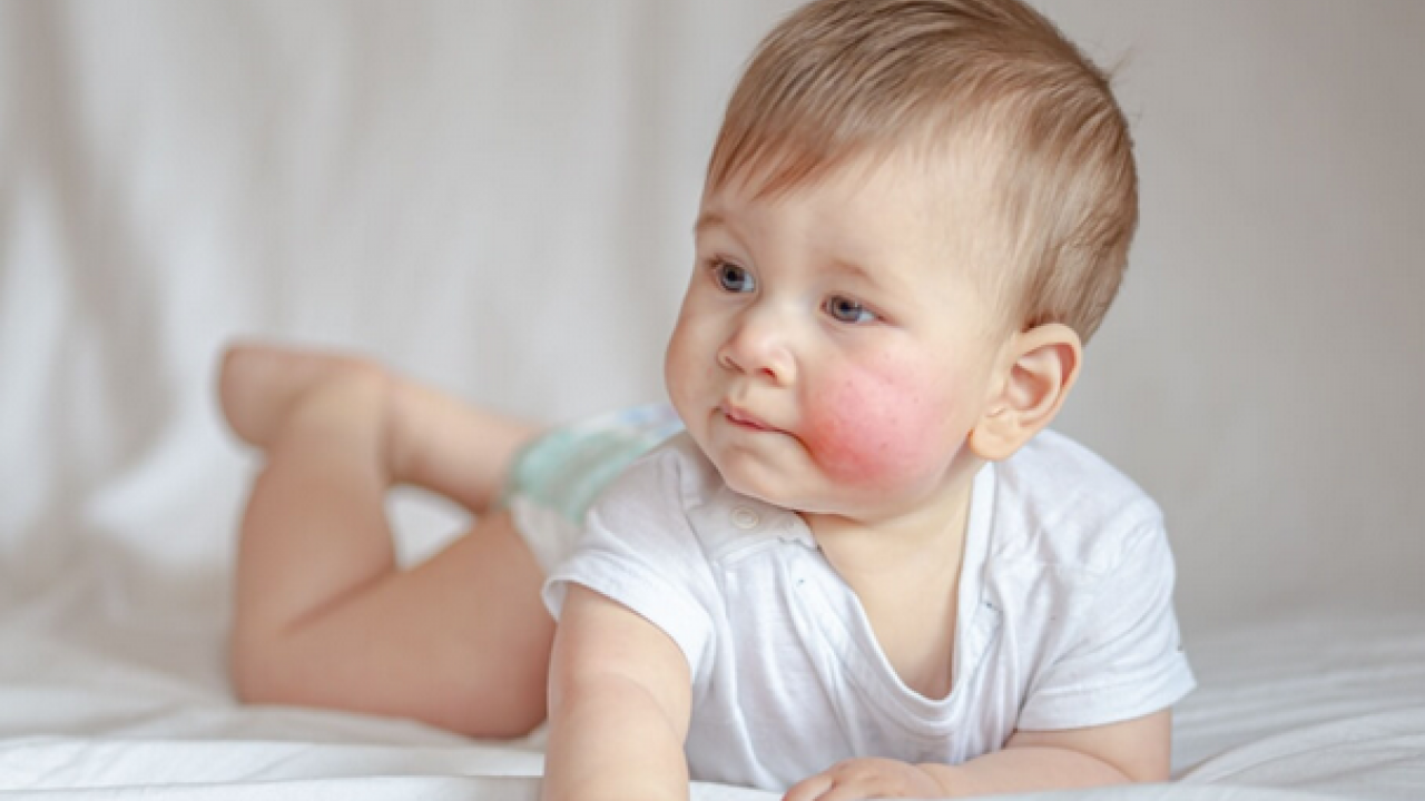 Foto - Hamileler ve çocuklarda besin alerjisine karşı alınması gereken önlemler! 