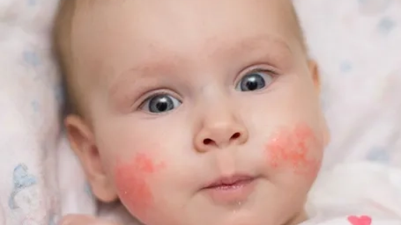 Foto - Hamileler ve çocuklarda besin alerjisine karşı alınması gereken önlemler! 