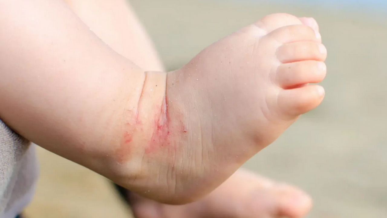 Foto - Hamileler ve çocuklarda besin alerjisine karşı alınması gereken önlemler! 