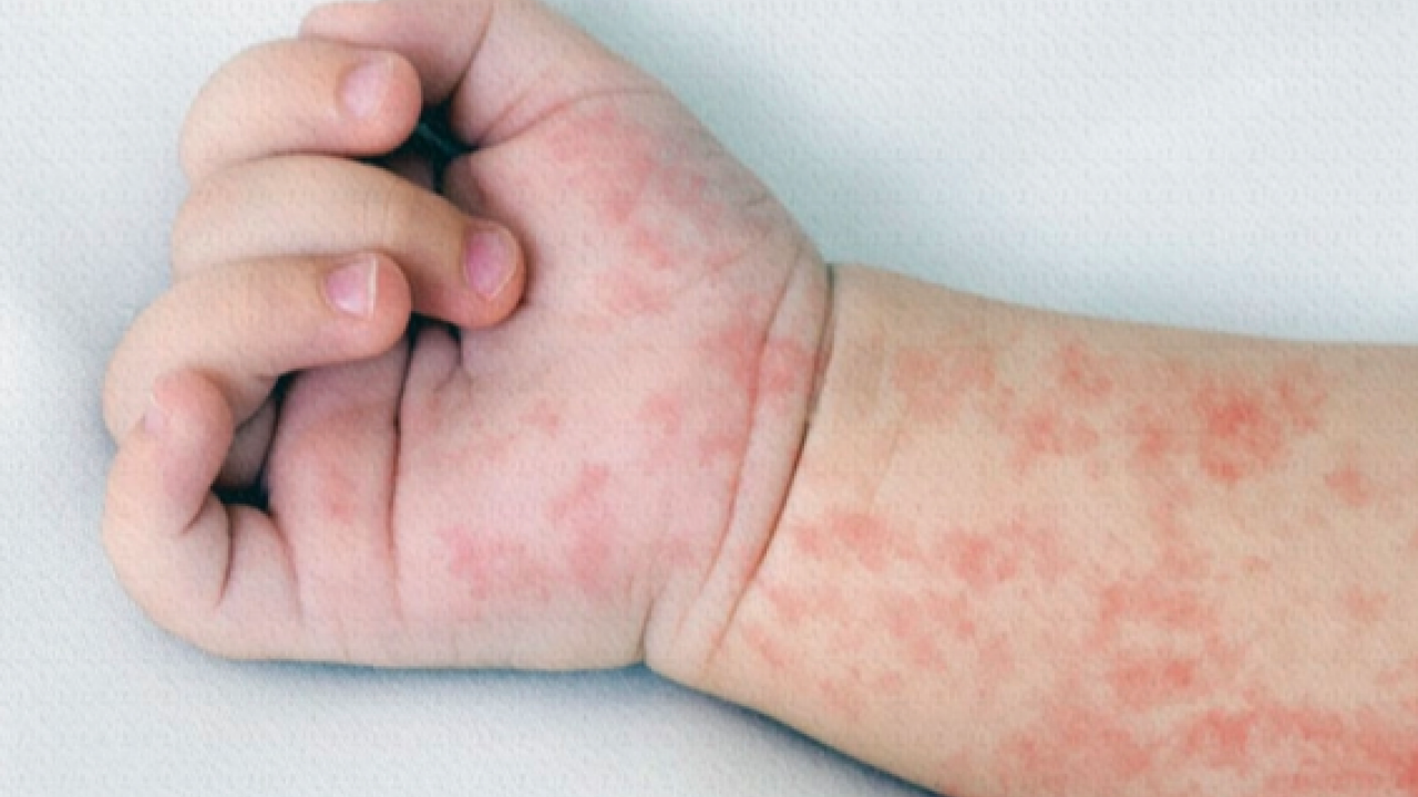 Foto - Hamileler ve çocuklarda besin alerjisine karşı alınması gereken önlemler! 