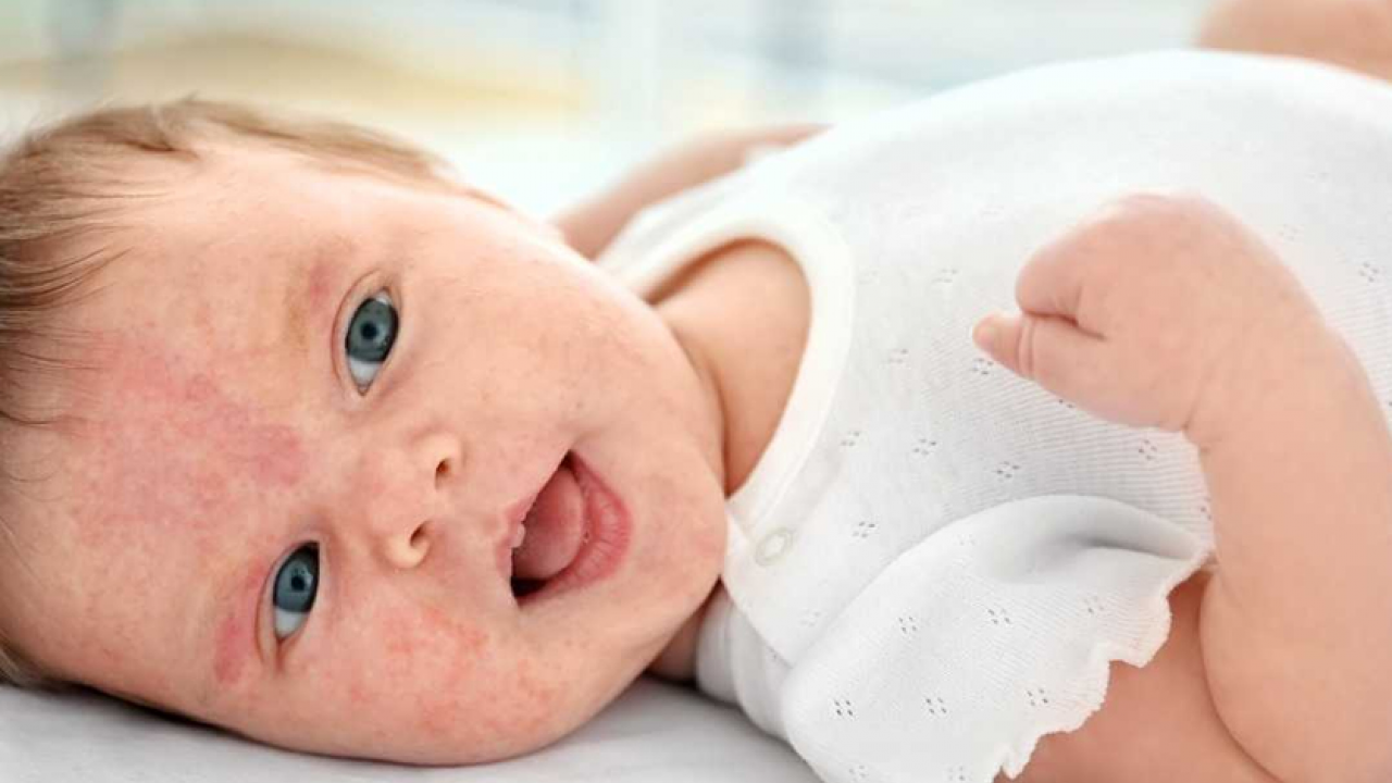 Hamileler ve çocuklarda besin alerjisine karşı alınması gereken önlemler! 