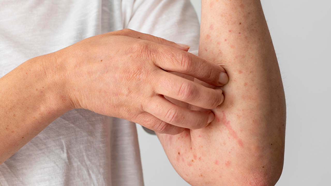 Foto - Hamileler ve çocuklarda besin alerjisine karşı alınması gereken önlemler! 