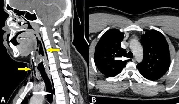 Foto - Hapşırığını tutanlar aman dikkat! Dünyada ilk kez görüldü! Bunu duyunca, bir daha kesinlikle yapmayacaksınız